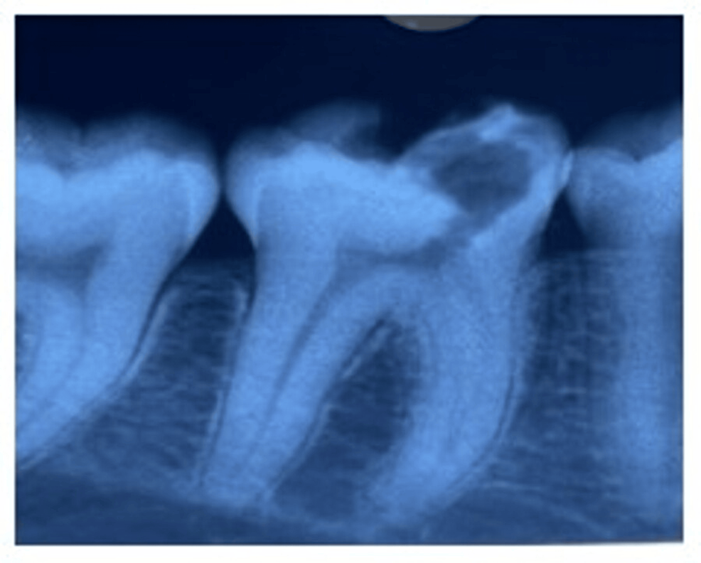 Anatomical Variations in Mandibular Molars: Focus on