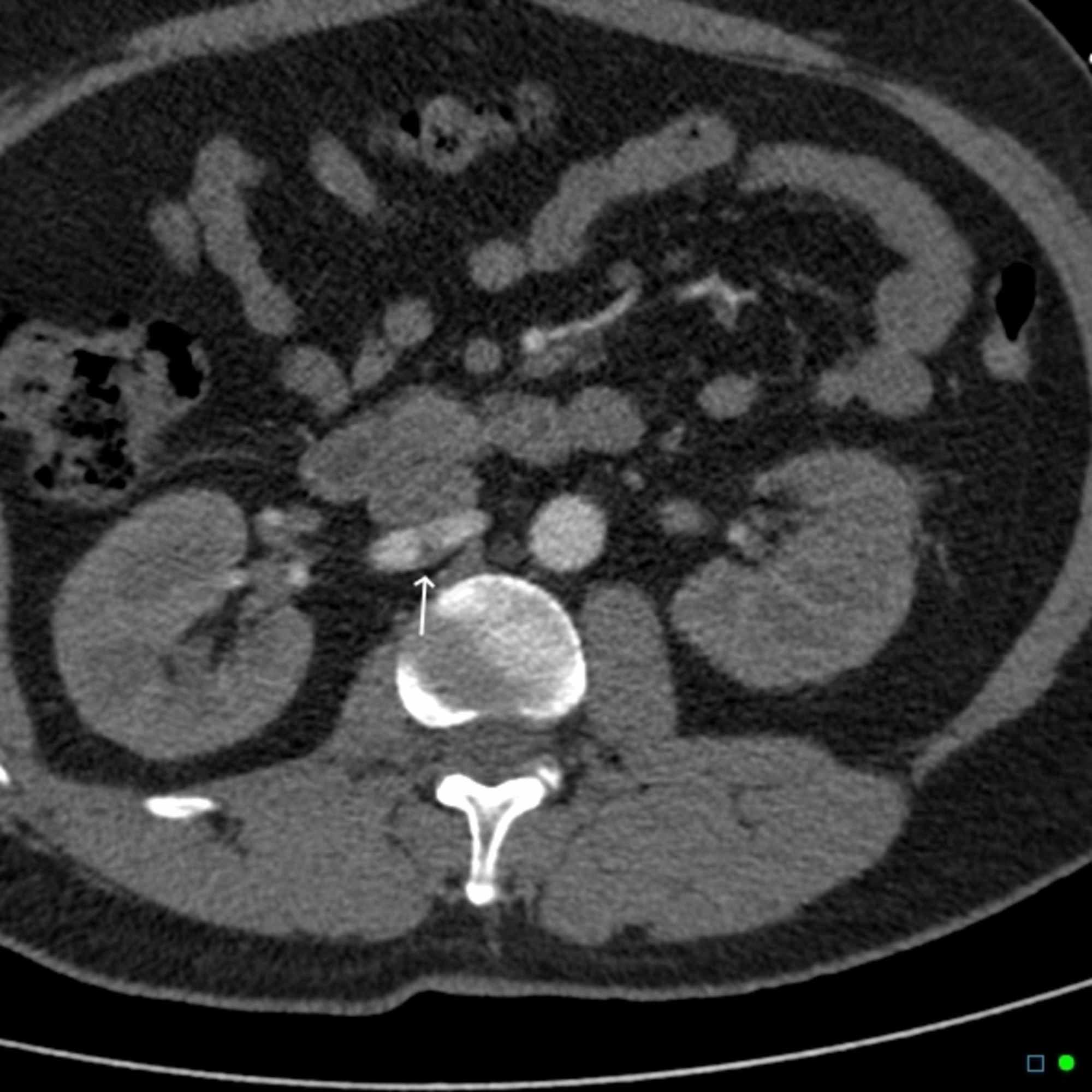 Cureus Isolated Renal Artery Dissection A Systematic Review of Case