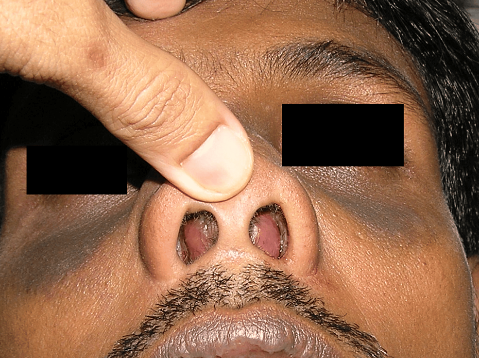 Nasal abscess hotsell