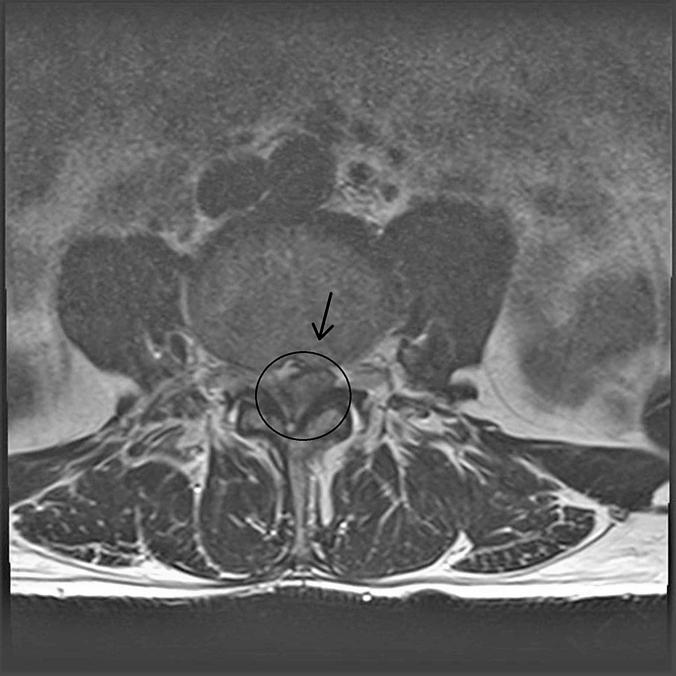 Cureus Intradural Disc Herniation A Case Report And Literature Review