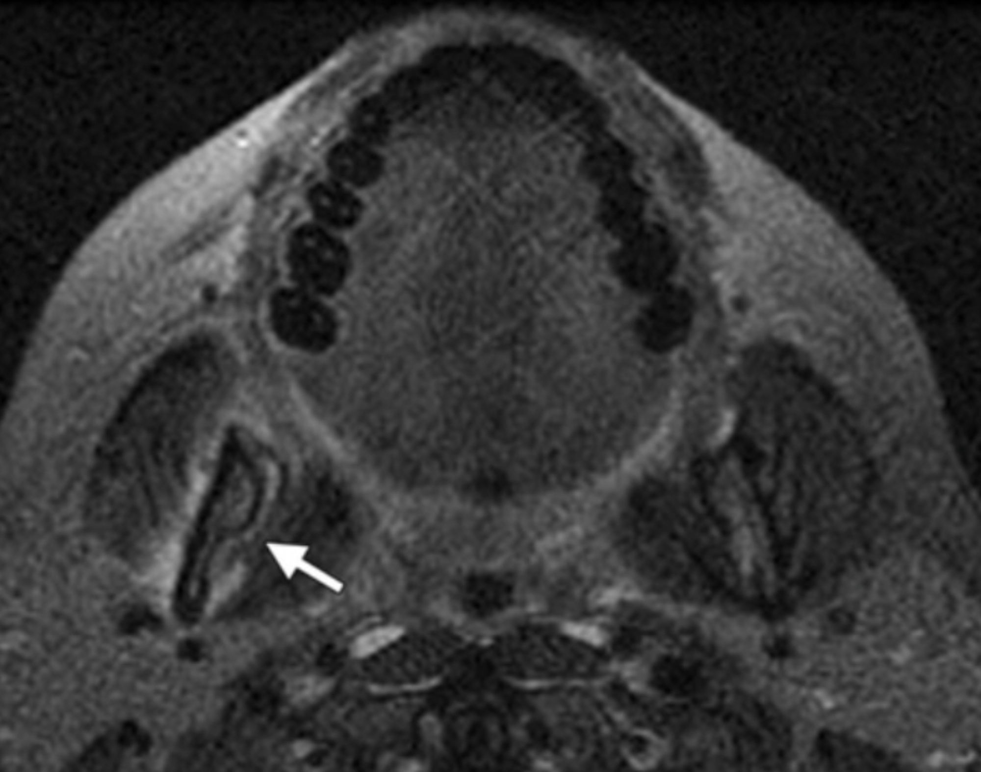 Cureus Medicationrelated Osteonecrosis of the Jaw A Review