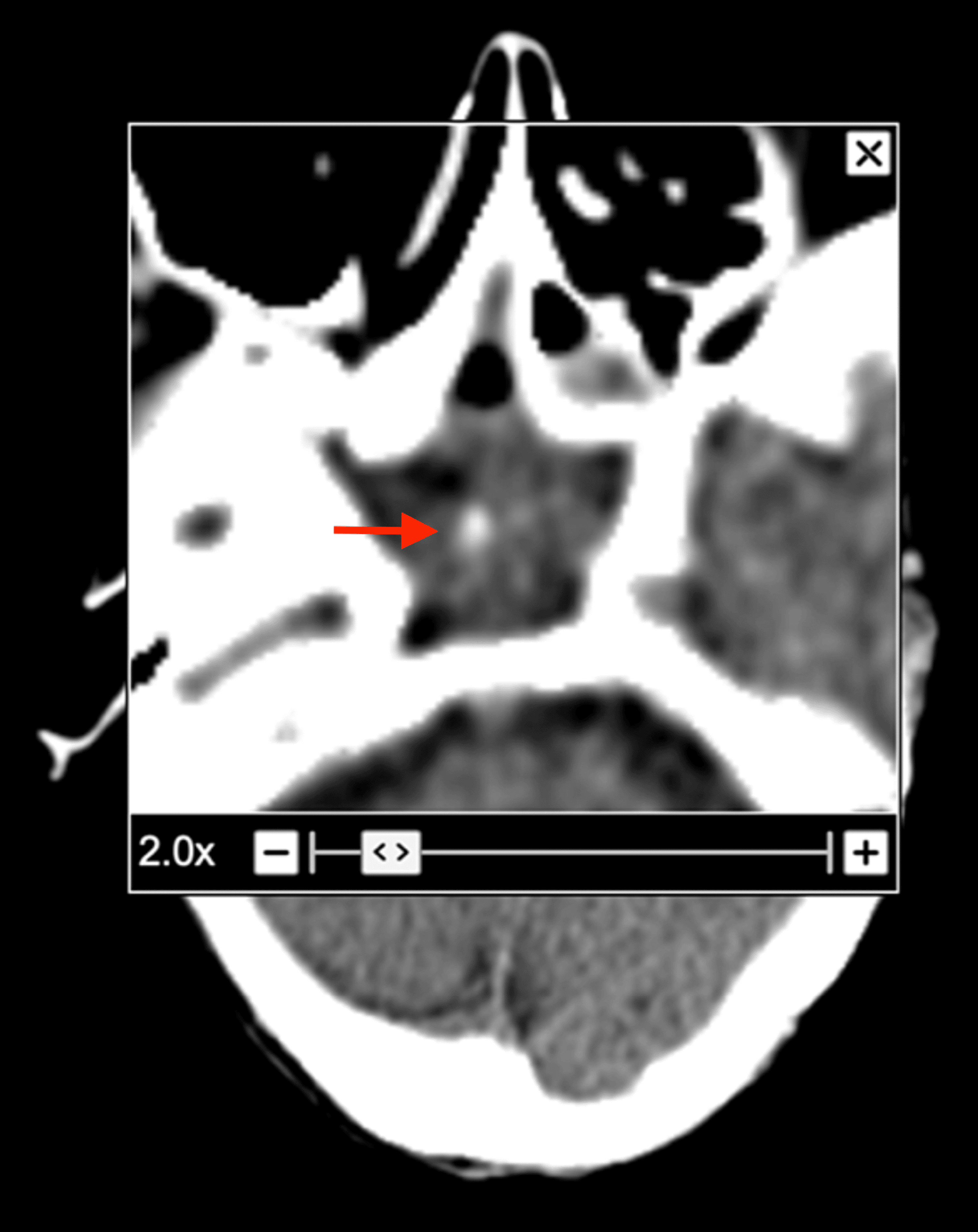 An Incidental Finding Of A Sphenoid Sinolith A Case Report Cureus