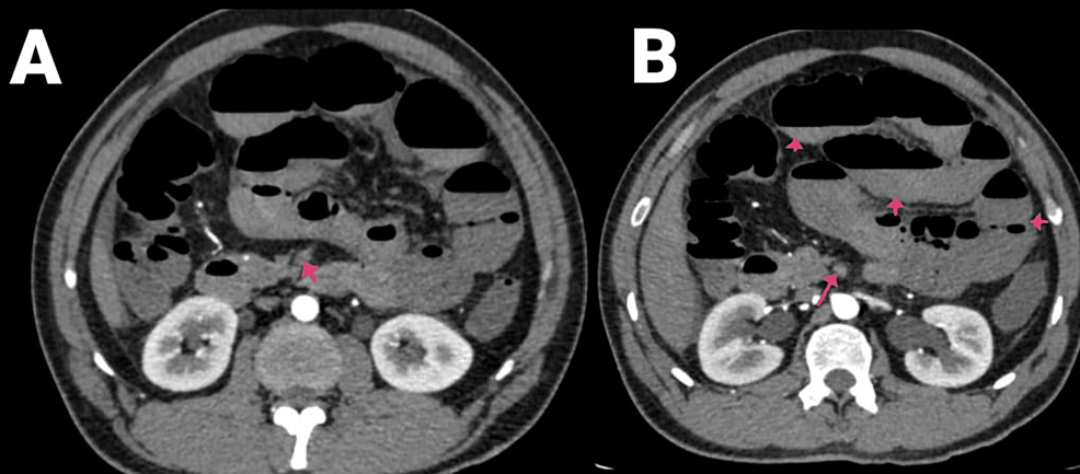 (A-and-B)-CECT-of-the-abdomen-and-pelvis-with-angiography-of-the-patient-(arrows-showing-SMA-thrombosis-and-air-fluid-levels).