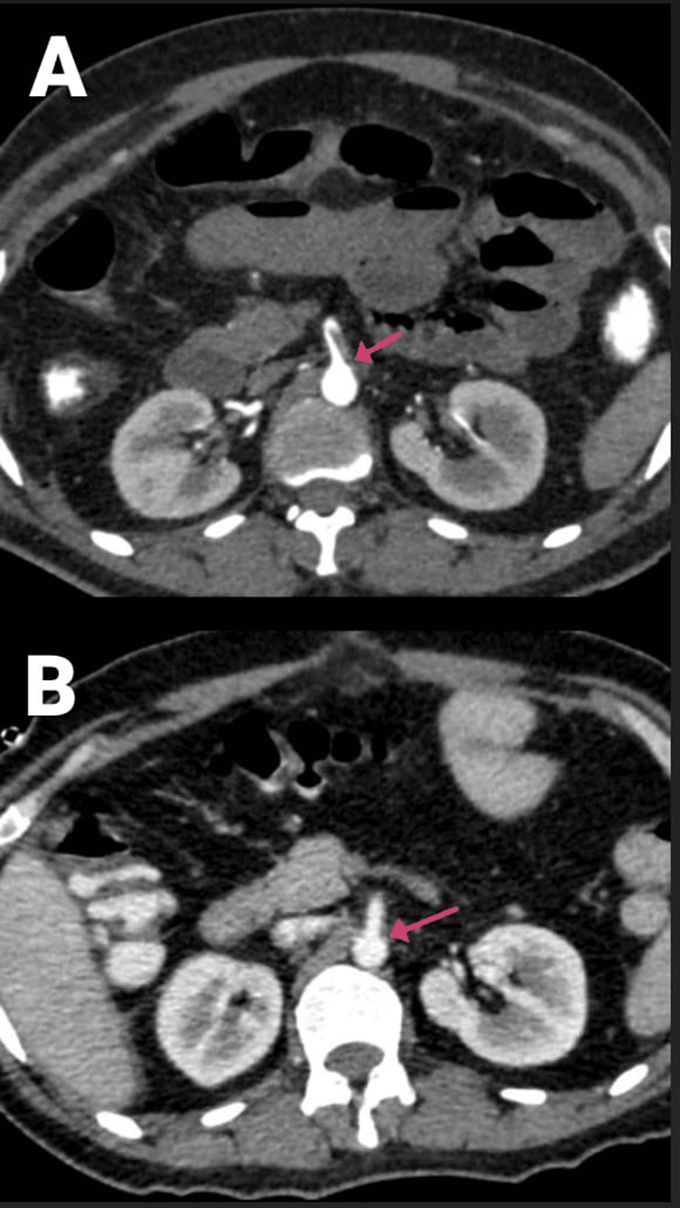 (A-and-B)-CECT-of-the-abdomen-and-pelvis-with-angiography-of-the-patient-(arrows-showing-a-partial-filling-defect-in-the-SMA-along-its-posterior-and-left-lateral-wall).