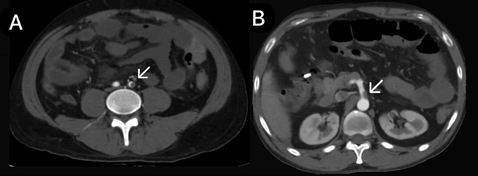 (A-and-B)-CECT-of-the-abdomen-and-pelvis-with-angiography-of-the-patient-(arrows-showing-the-SMA-thrombosis).