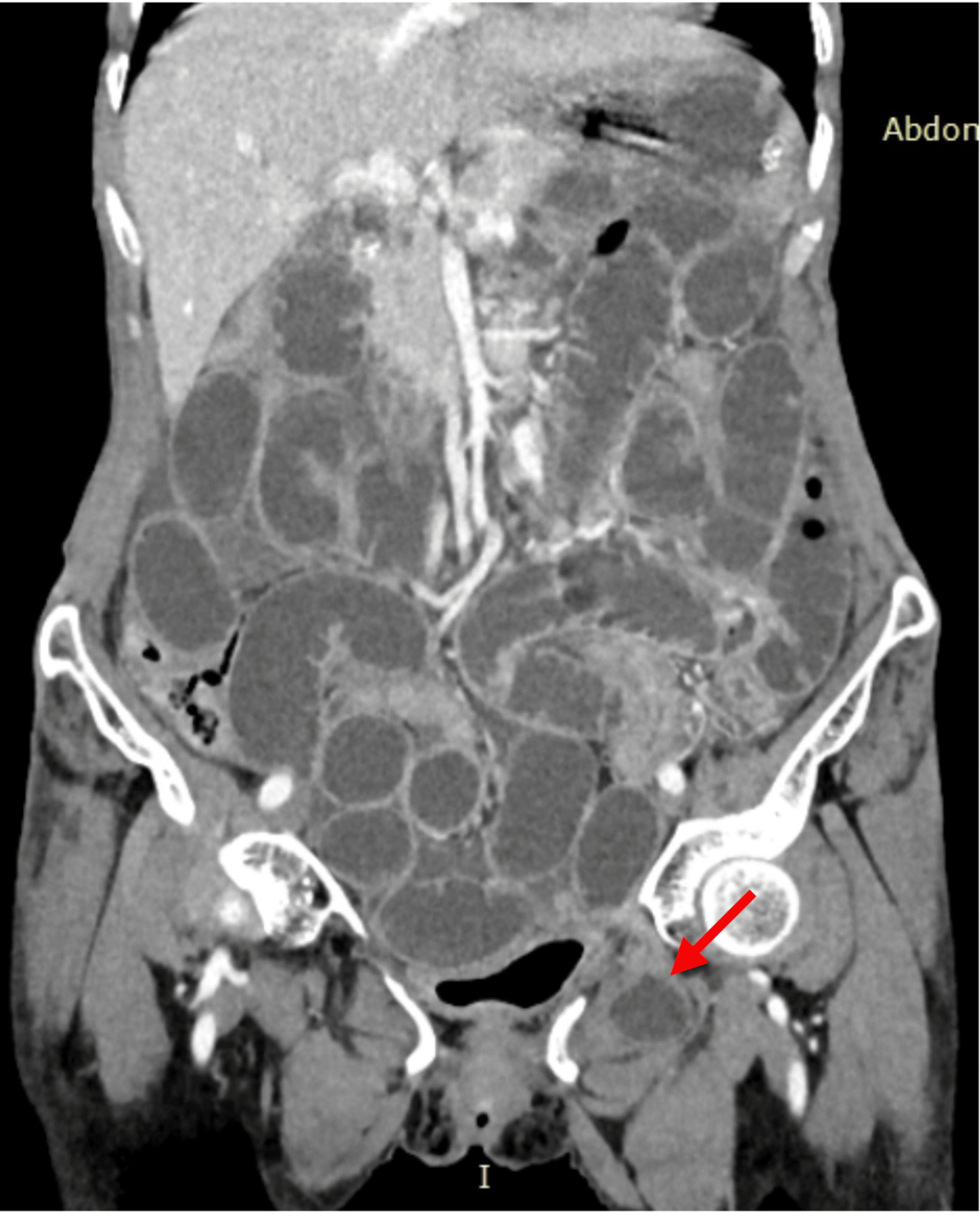 Acute Intestinal Obstruction Due To Obturator Hernia A Case Series