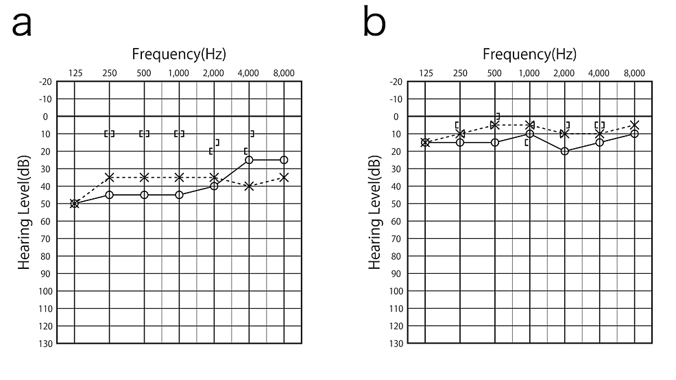 Cureus A Successful Case Report of Epipharyngeal Abrasive Therapy