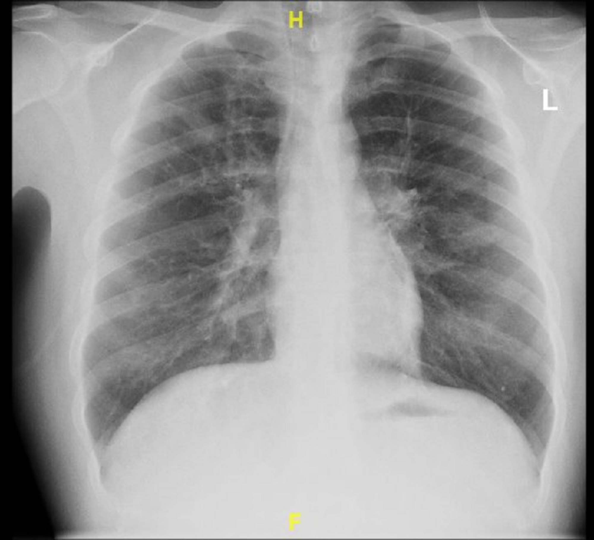 pneumonia chest x ray findings