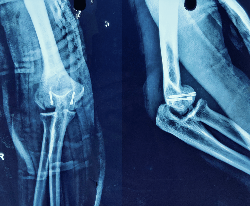 Cureus Surgical Management of a ThreeMonthOld MalUnited Dubberley