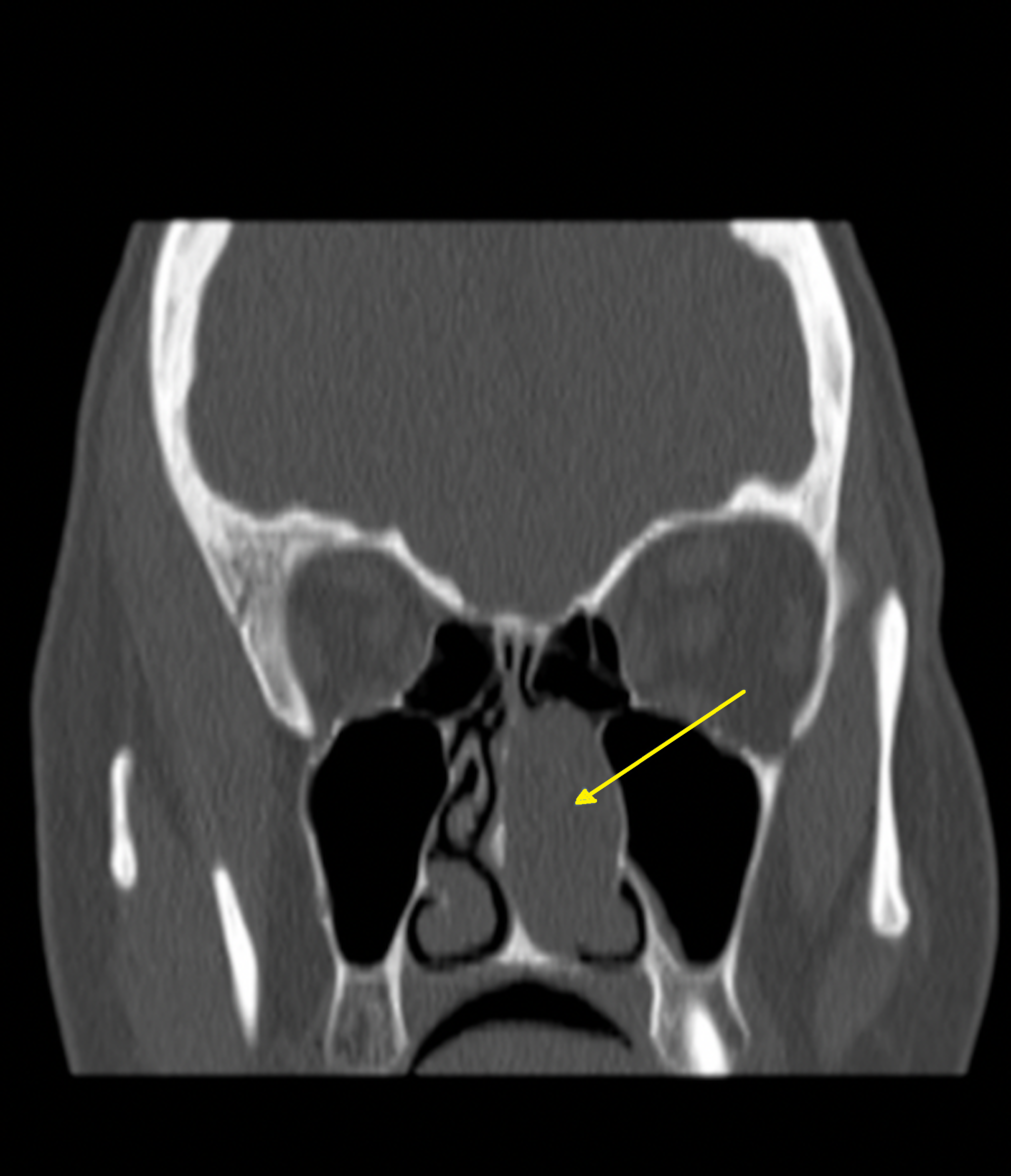 Nasal Polyps X Ray