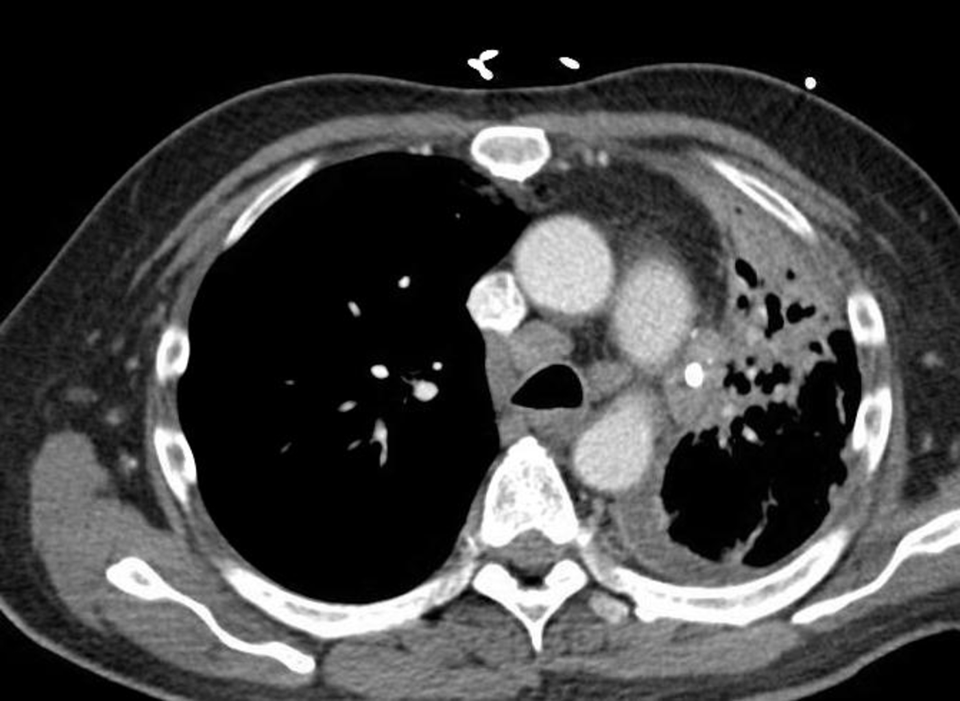 Cureus | Spontaneous Tumor Lysis Syndrome in Small Cell Lung Cancer