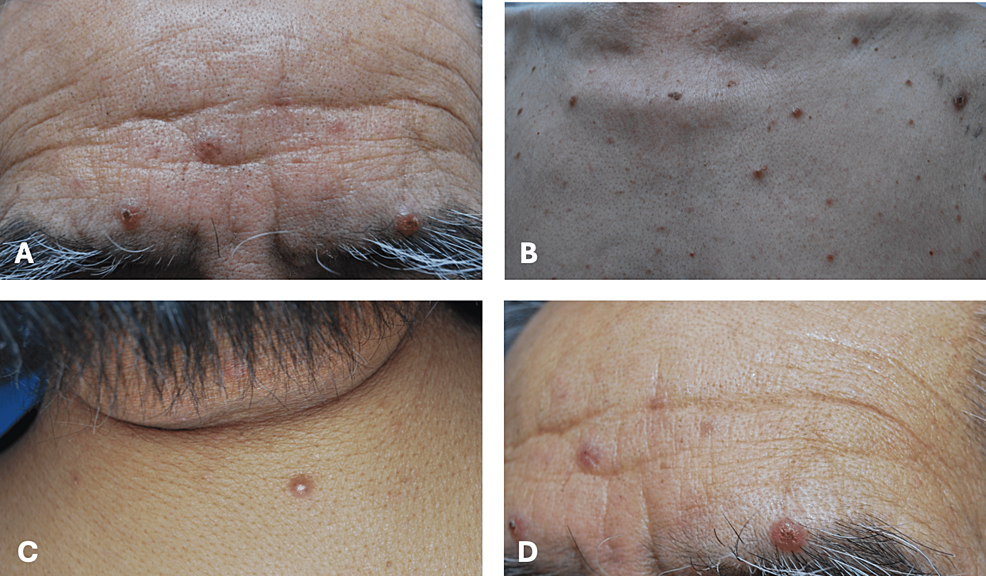 Symptoms of Histoplasmosis in Humans: Key Signs You Should Know