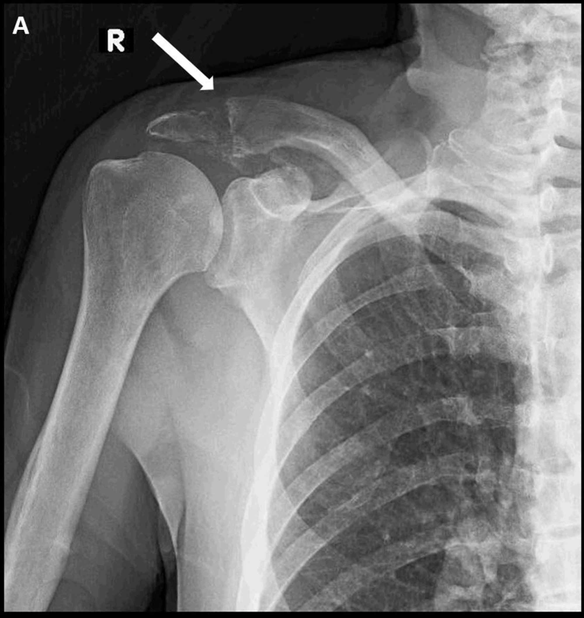 Cureus Multifocal Lytic Lesions in a Patient with Myelofibrosis A
