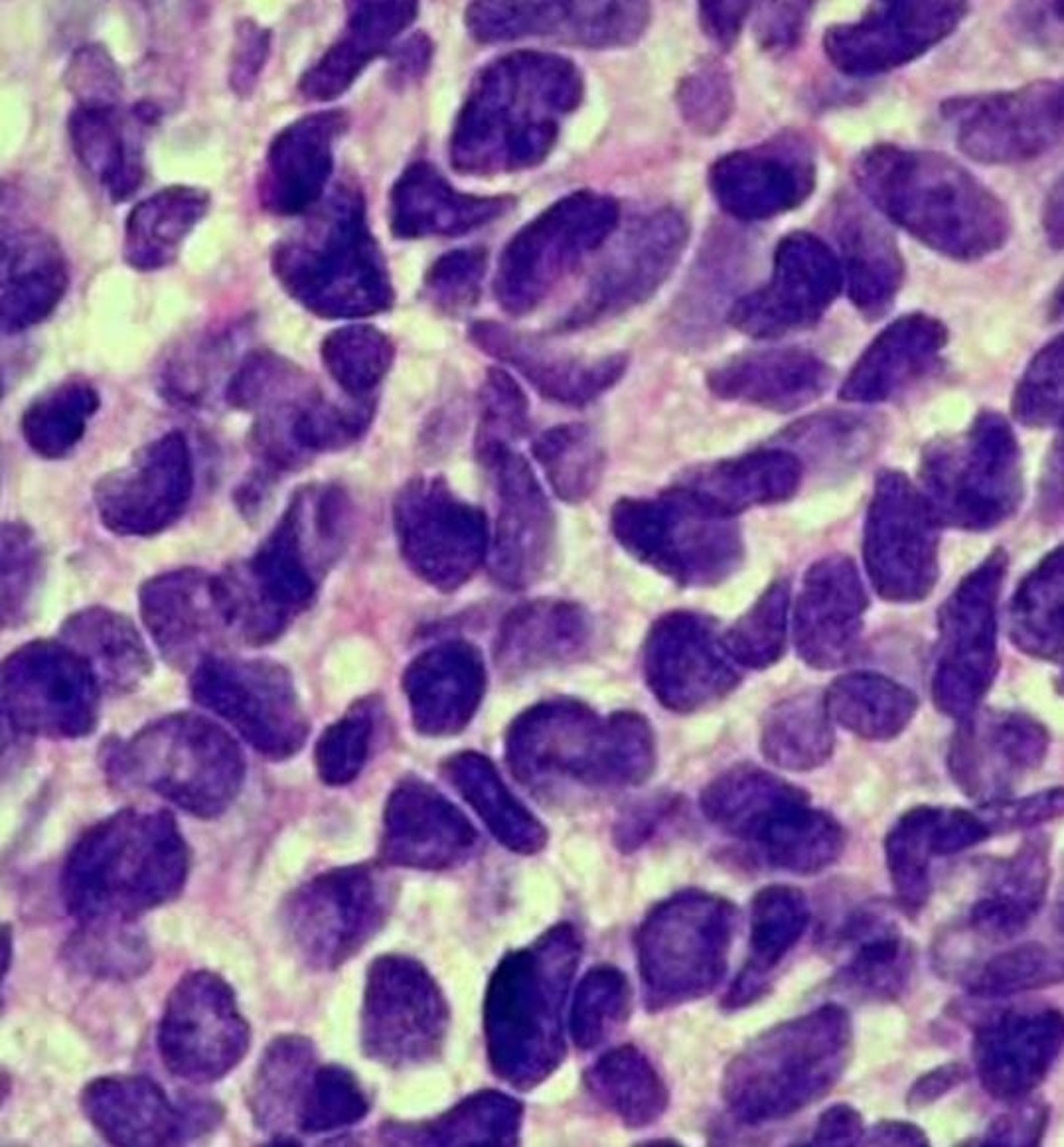 Lung cancer small cells