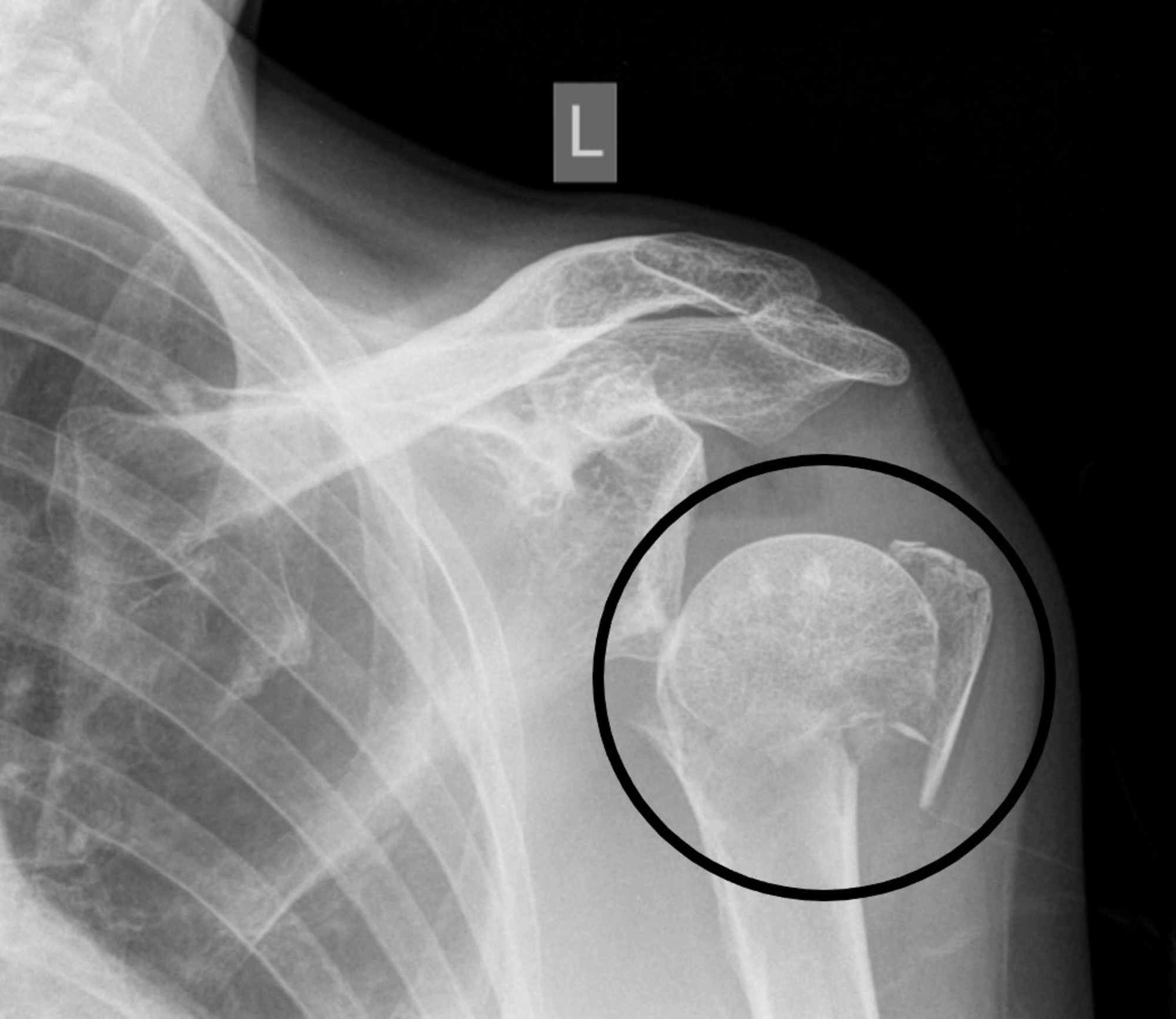 Types Of Proximal Humerus Fractures