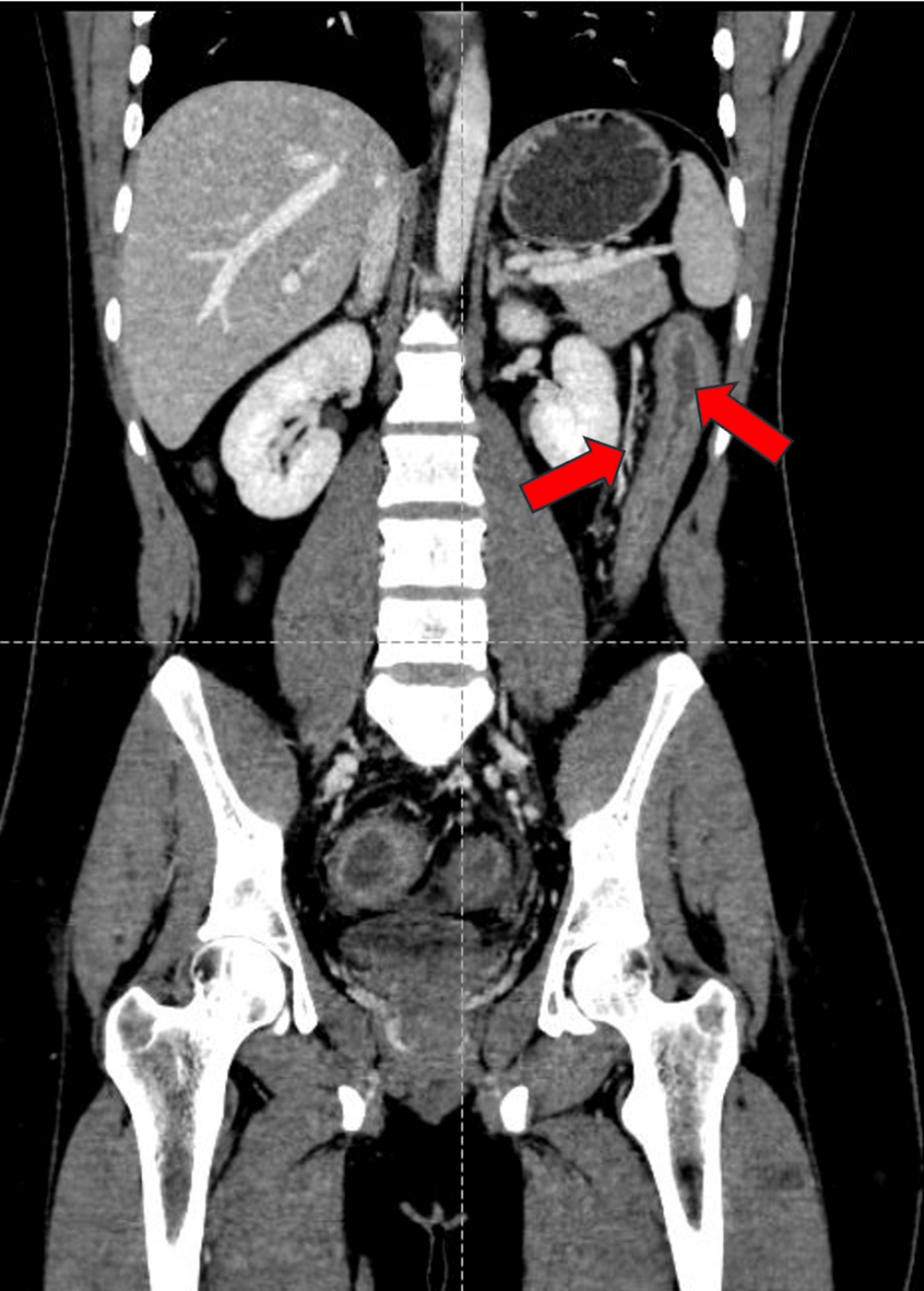 Cureus | An Unusual Case Of An Immunocompetent Adult Diagnosed With ...