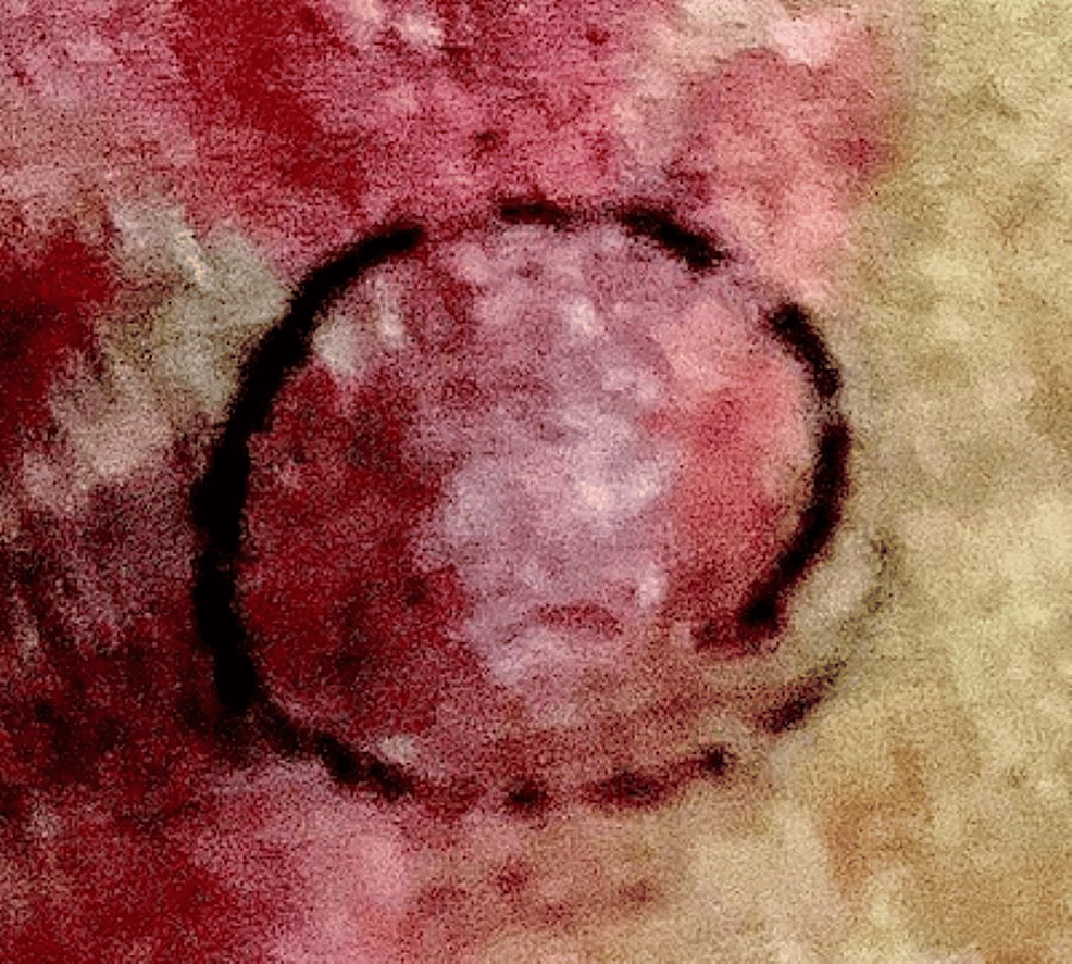 Pink and Orange Tattoo Pigments: Two Occurrences of Squamous Cell Neoplasms  | Cureus, image size:986x887