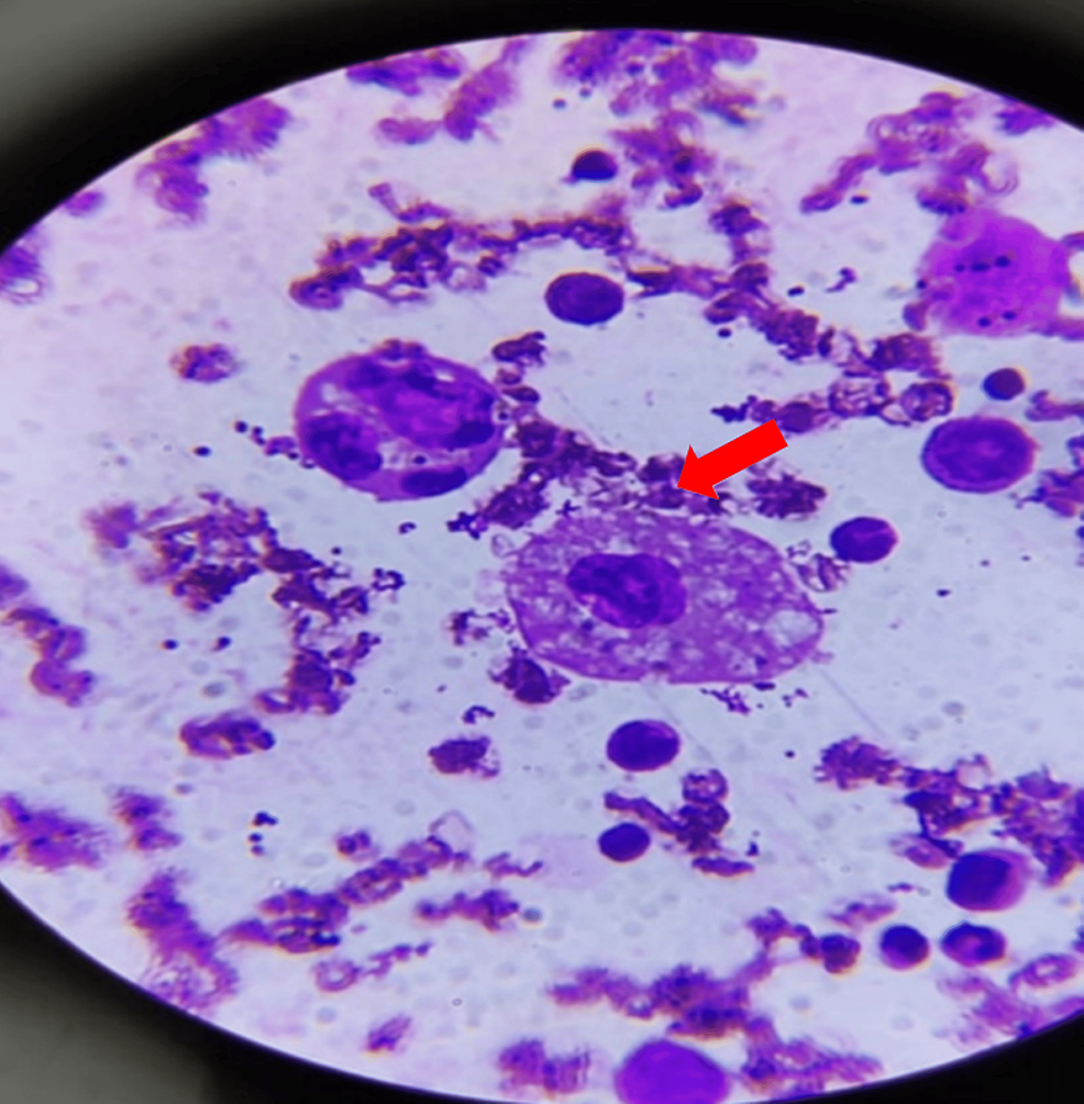 Hemolimfocytoza wtórna do gorączki denga u dziecka: opis przypadku