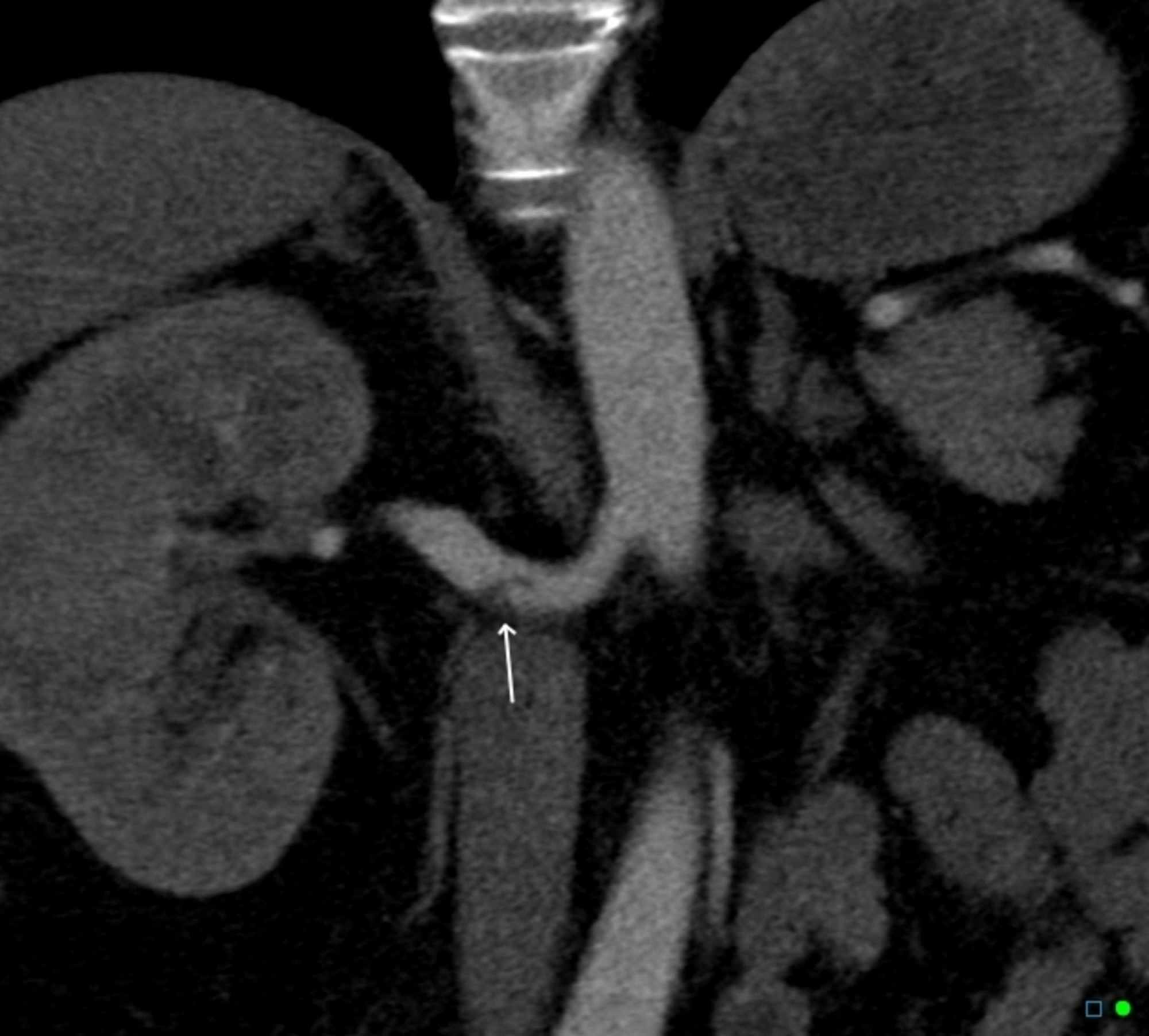 Isolated Renal Artery Dissection A Systematic Review of Case Reports