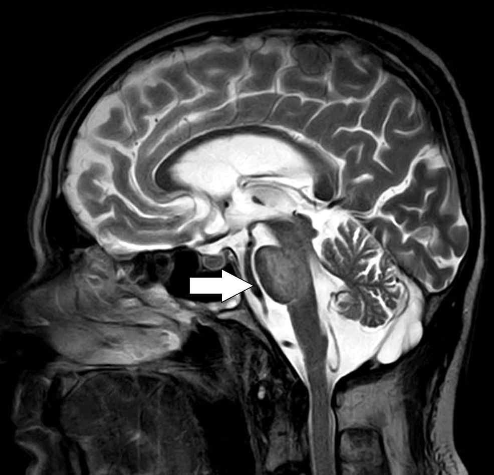 Central Pontine Myelinolysis: A Rare and Life-Threatening Adverse ...