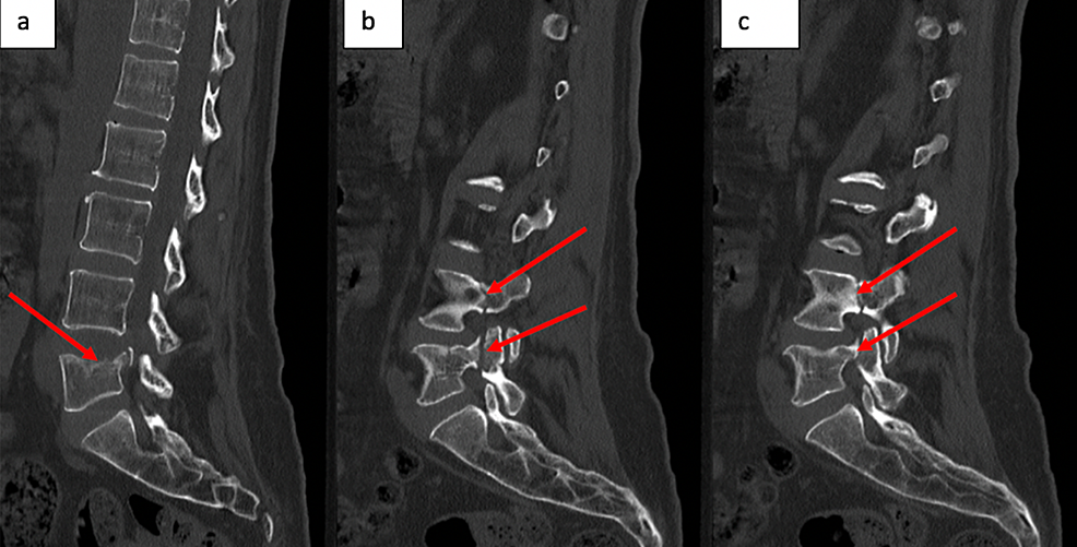 A lumbar compression fracture at L4 treated with a vertebral body