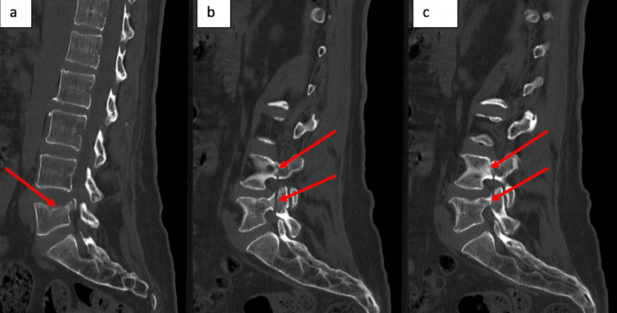 lumbar-fracture-types