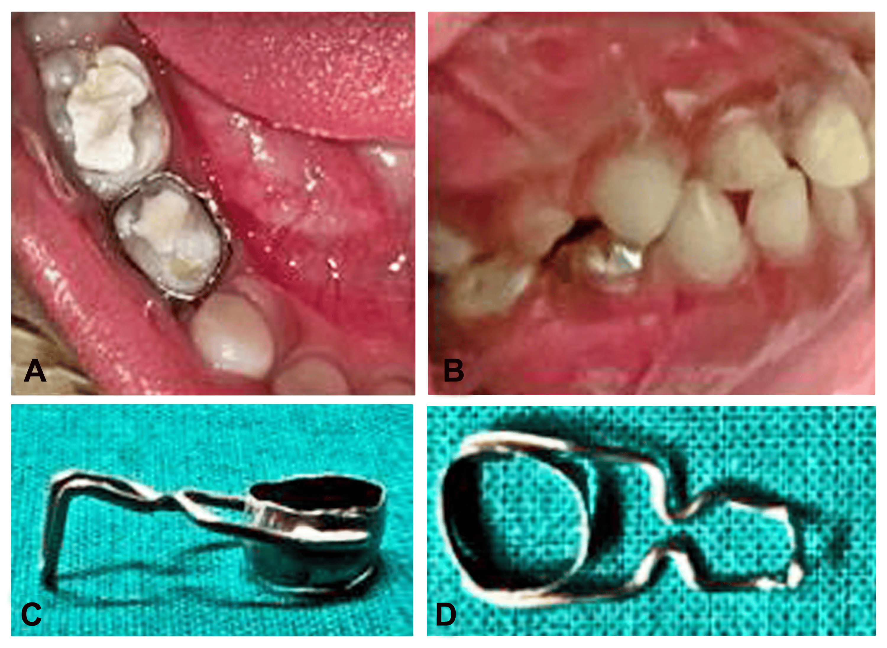 A Leap Beyond Traditional Methods A Case Report on the Horizontal Loop
