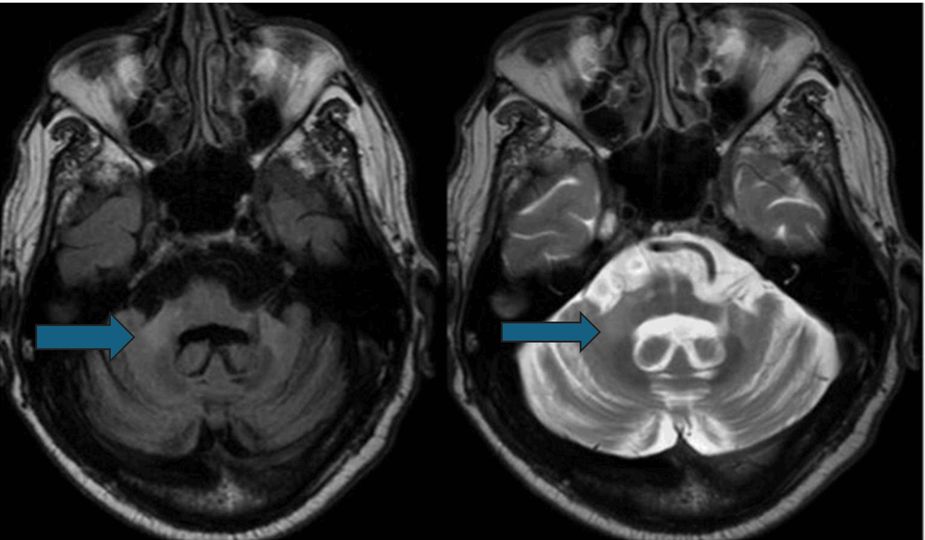 Imaging Markers of Multiple System Atrophy and Their Association With ...