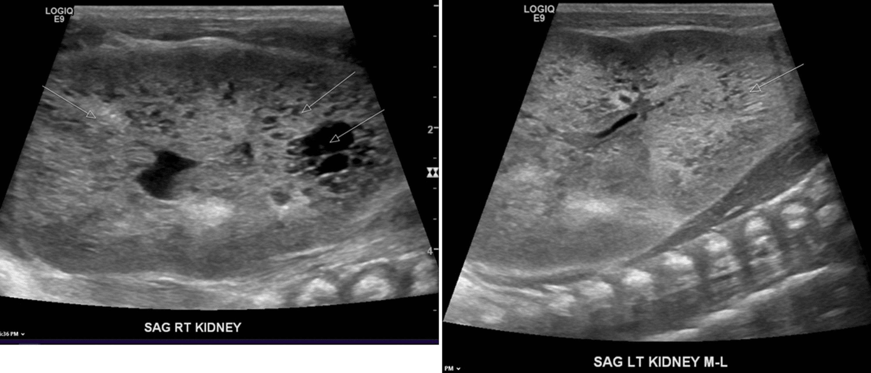 Cureus Variable Clinical Presentations and Renal in Neonates