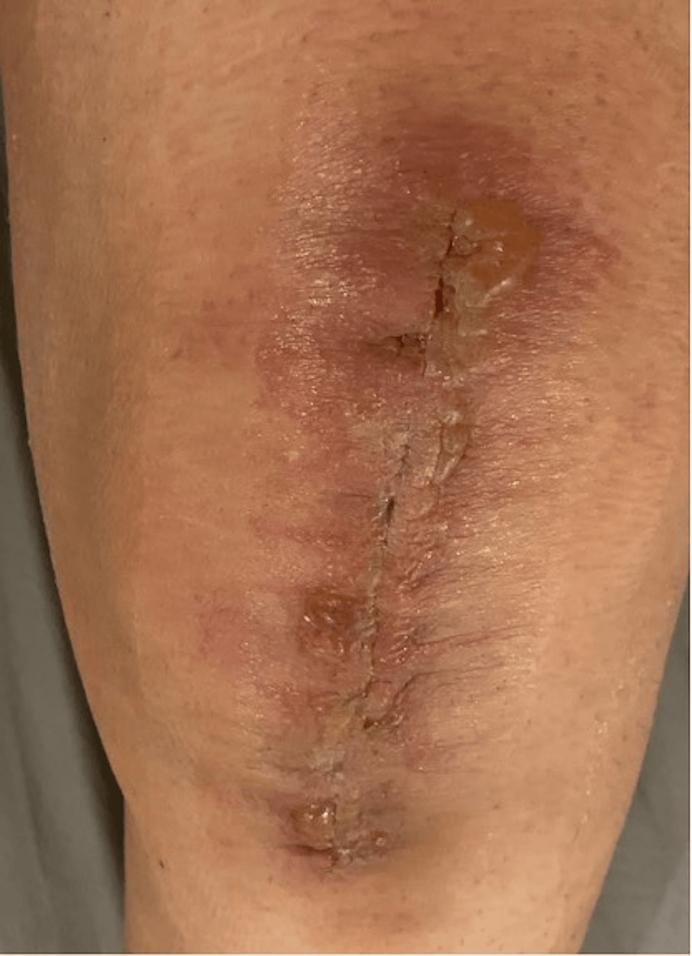 Cureus Association of Surgical Adhesive and Glue System With