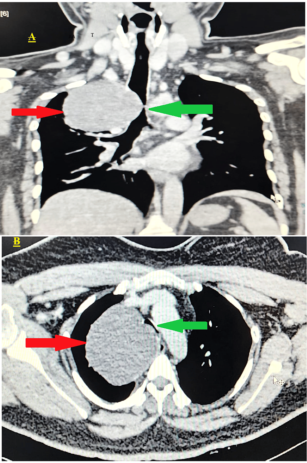 CT-thorax.-(A)-Coronal-section-(red-arrow-showing-large-BC-in-the-paratracheal-region-of-the-superior-mediastinum-and-green-arrow-pointing-toward-severe-tracheal-compression-of-the-lower-one-third-of-the-trachea).-(B)-Axial-section-(red-arrow-showing-BC-and-green-arrow-showing-severe-tracheal-narrowing).