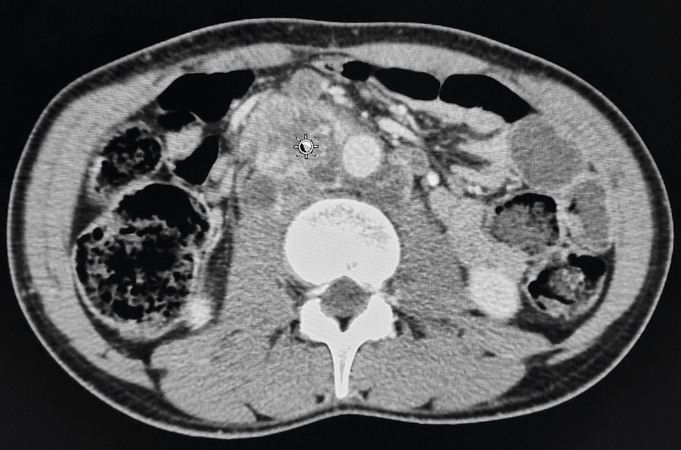 Therapeutic Strategy for Functional Metastatic Malignant Paraganglioma ...