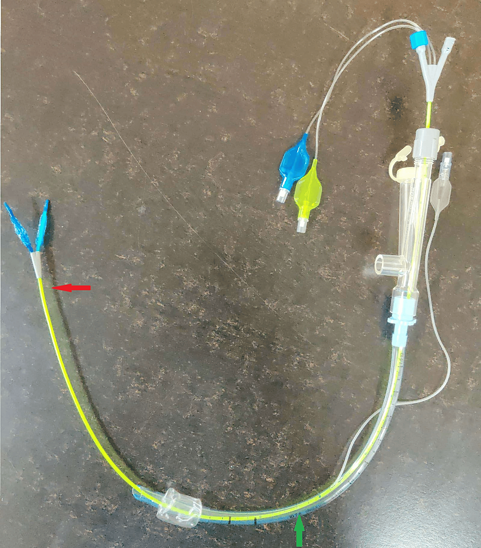 EZ-bronchial-blocker.-The-green-arrow-points-to-the-ET,-and-the-red-arrow-points-to-the-Y-shaped-tip-of-the-blocker.