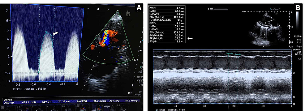 Color-Doppler-echocardiography-by-continuous-wave-tracing-in-suprasternal-view-showing-pressure-gradient-across-aortic-valve-(A)-and-parasternal-long-axis-view-showing-left-ventricular-dimension-and-ejection-fraction-(B)