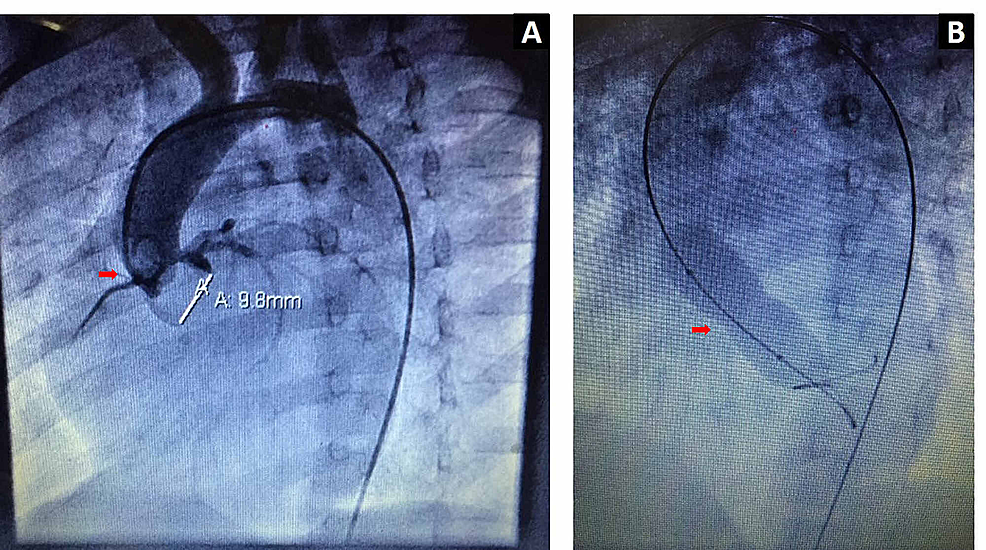 Aortic-root-angiogram-in-the-left-anterior-oblique-view-showing-aortic-valve-annulus-(A)-and-balloon-dilatation-(B)
