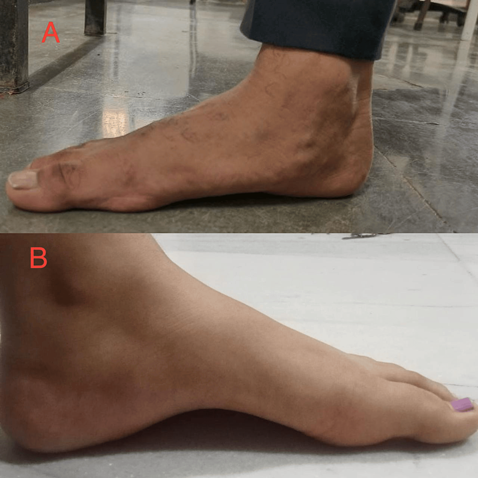The Effect of Foot Rehabilitation Protocol in Adults With Congenital