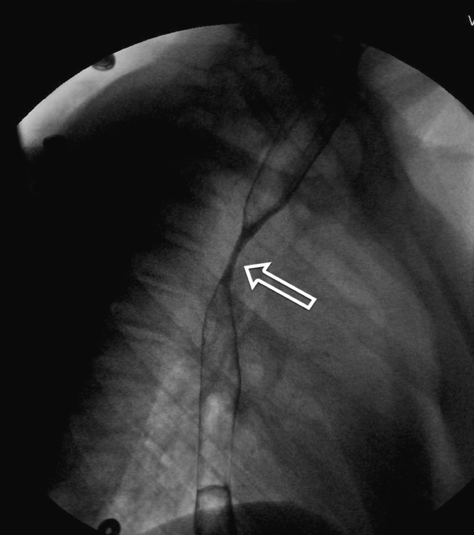 Cureus Persistent Vomiting and Weight Loss Leading to the Diagnosis