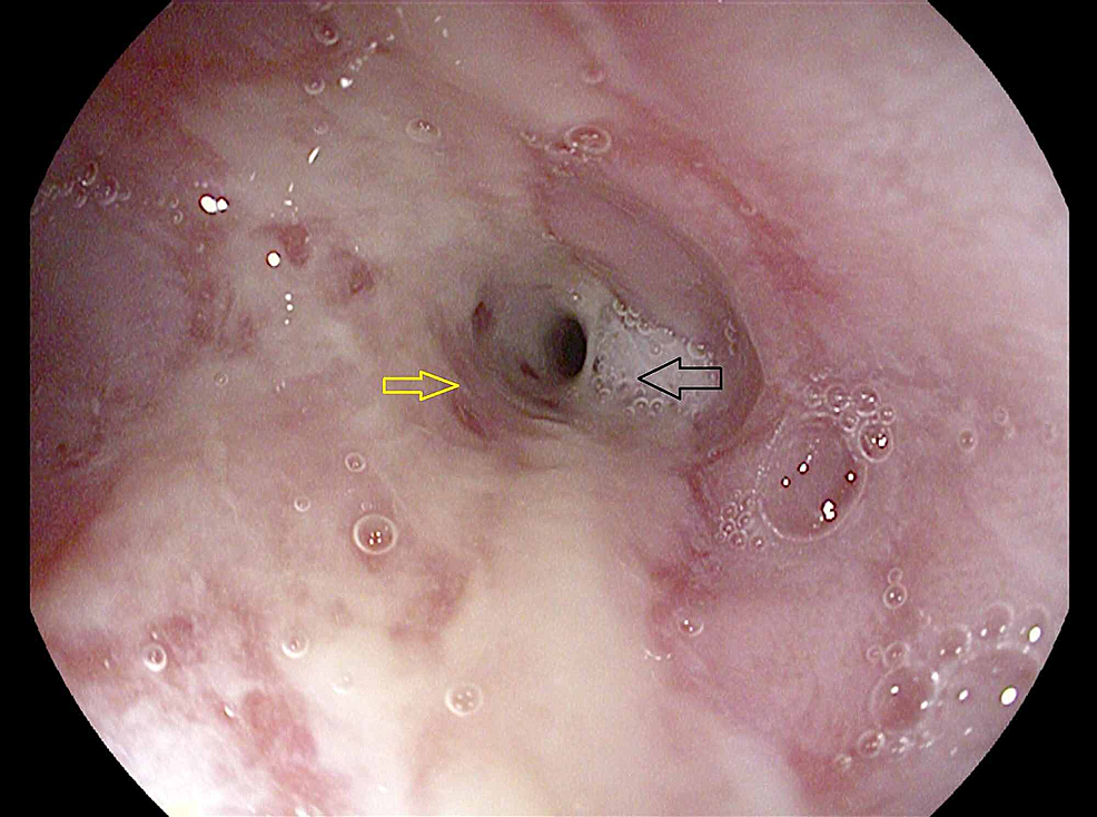 Cureus Persistent Vomiting and Weight Loss Leading to the Diagnosis