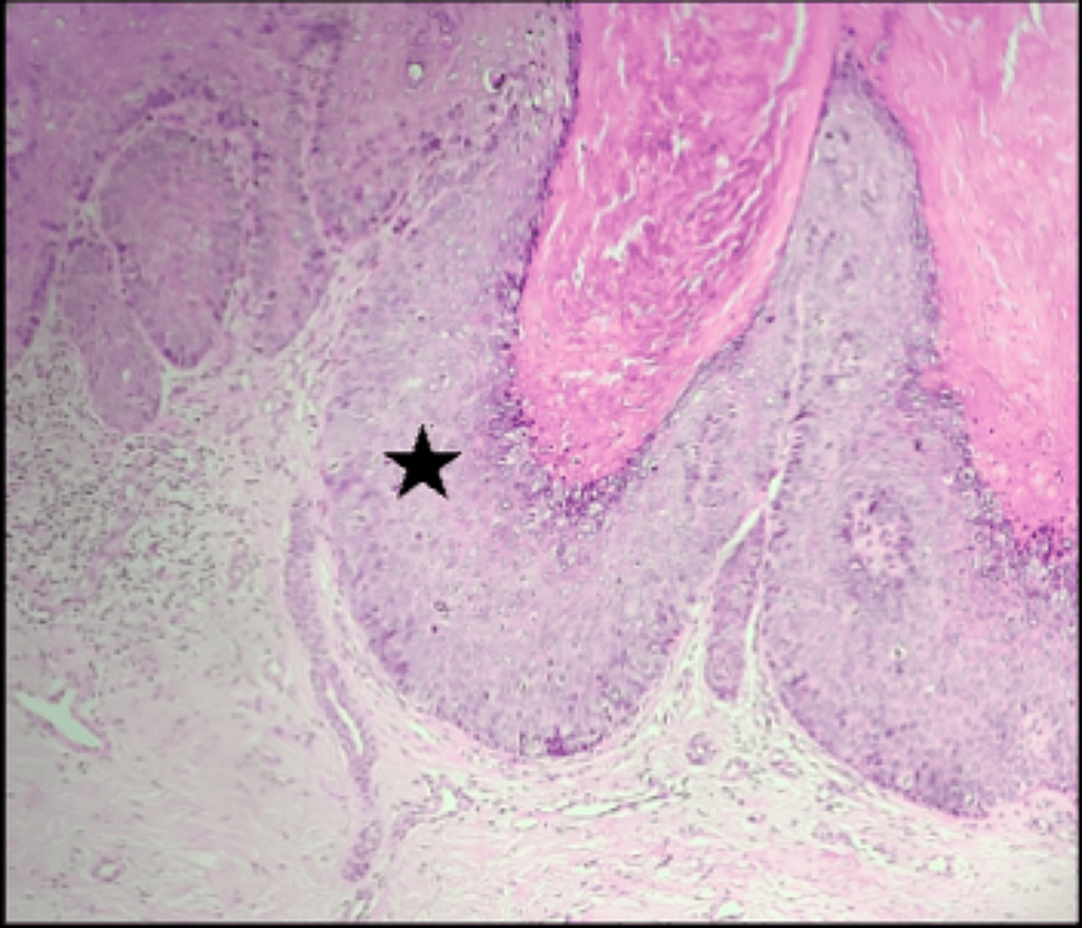 Clinical, Dermoscopic and Histopathological Features of Non-melanoma ...