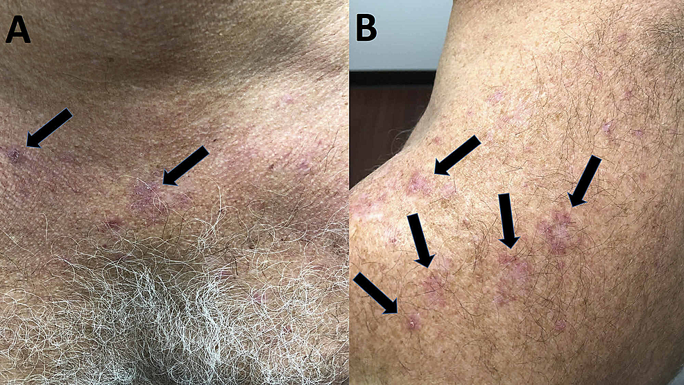 cureus-atorvastatin-induced-lichenoid-drug-eruption-a-case-report