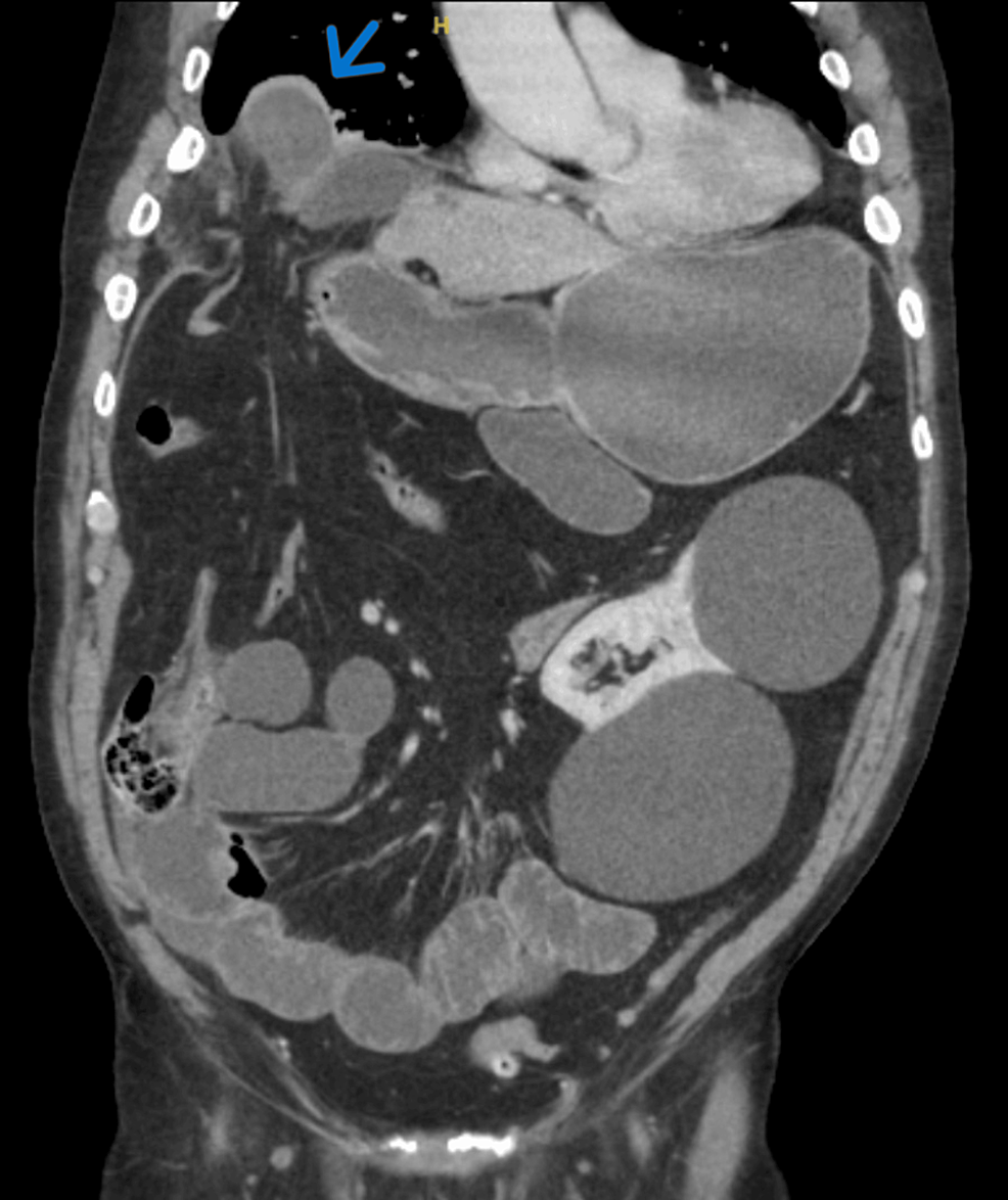 Spontaneous Right-Sided Diaphragmatic Hernia: A Rare Cause of Small Bowel  Obstruction | Cureus, image size:986x1174