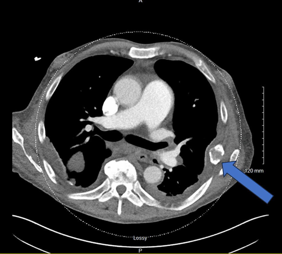 Cureus Brown Tumor From Secondary Hyperparathyroidism Mimicking