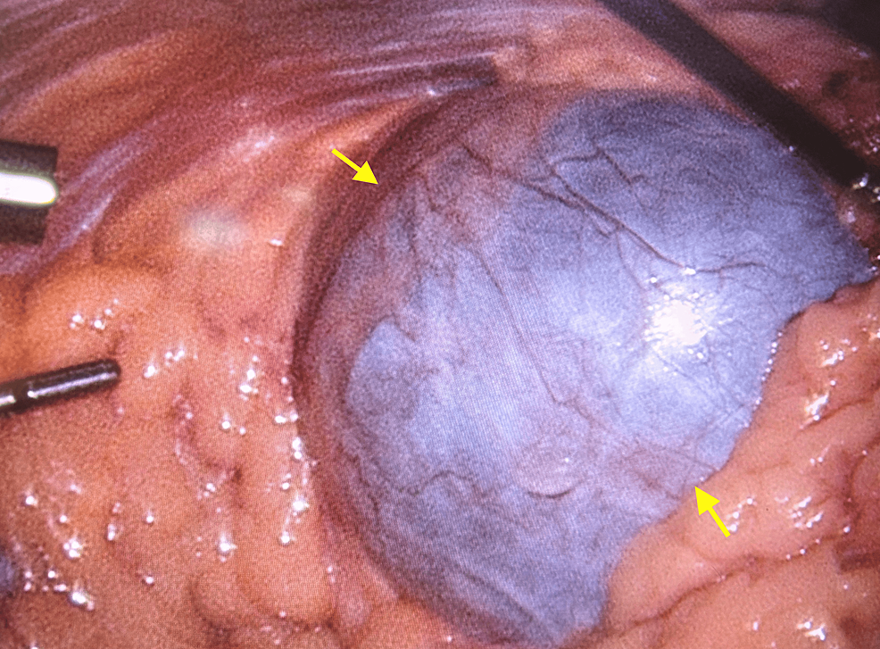 ちなみに待機的肥満手術で巨大な良性卵巣漿液性嚢胞腺腫が発見された
