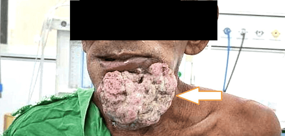 Image-showing-large-extraoral-fungation Image-showing-large-extraoral-fungation