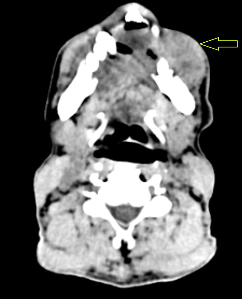 Contrast-enhanced-CT-showing-extraoral-fungating-mass-with-no-intraoral-extension Contrast-enhanced-CT-showing-extraoral-fungating-mass-with-no-intraoral-extension