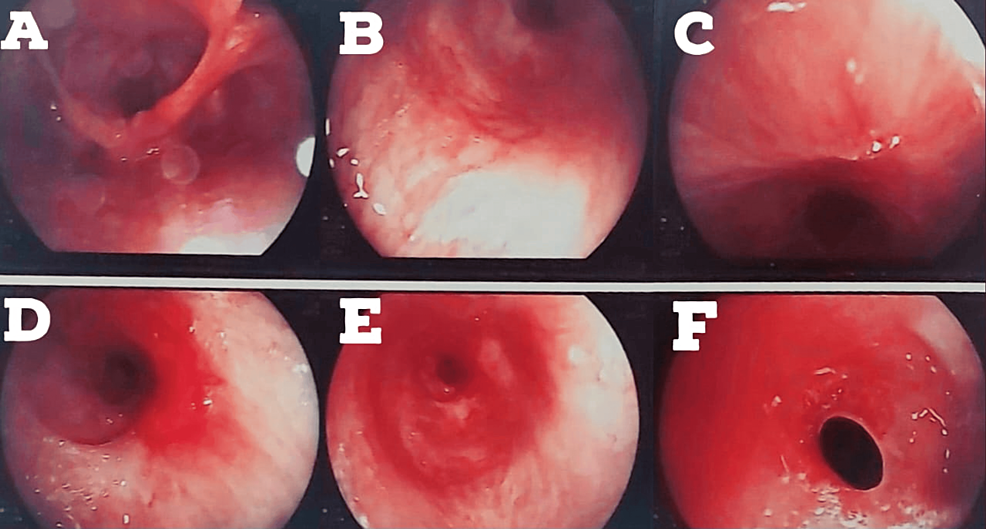 Bronchoscopy-image-dated-August-24,-2022