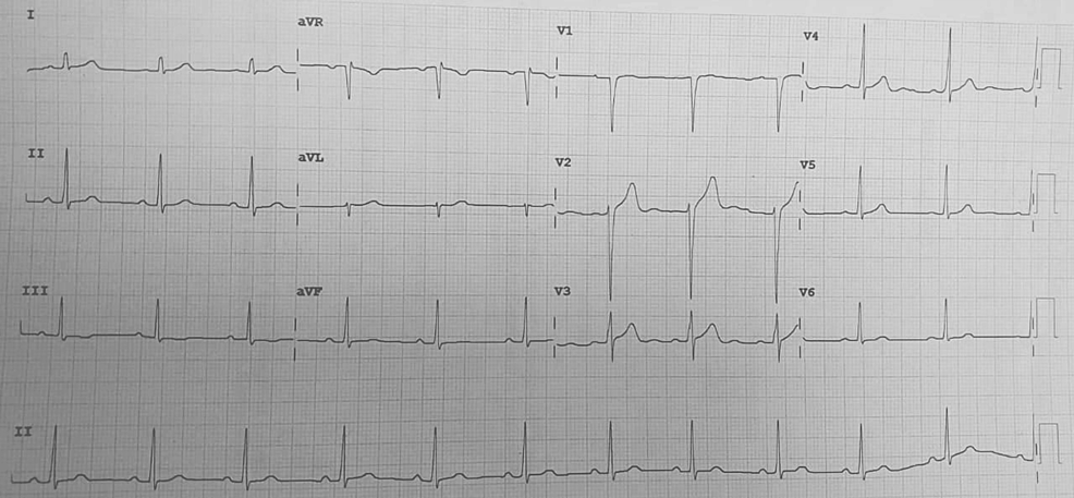 ECG-on-the-day-of-admission-depicting-normal-sinus-rhythm