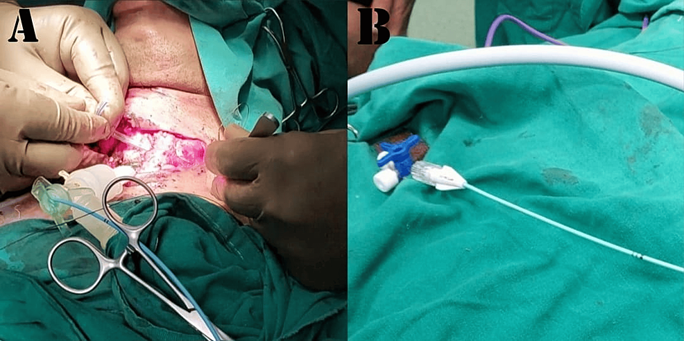 Image-showing-the-inflated-end-of-the-Fogarty-catheter-coming-out-through-the-suction-port-of-the-catheter-mount