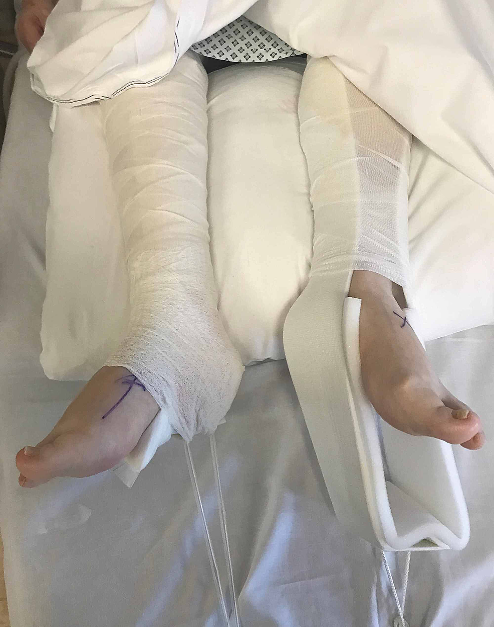 Cureus An Unorthodox Skin Traction Technique for the Initial