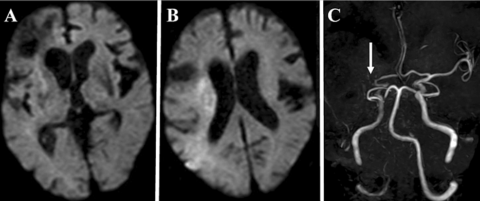 Stent Retriever Angioplasty For Acute Restenosis Of The Middle Cerebral 